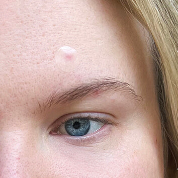 Pimple Patches: la tendencia de skincare que ayuda a cicatrizar los granitos y conquista las redes